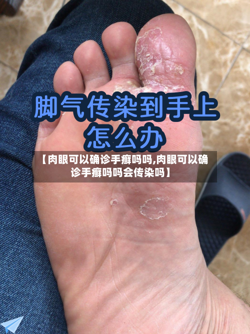 【肉眼可以确诊手癣吗吗,肉眼可以确诊手癣吗吗会传染吗】-第2张图片