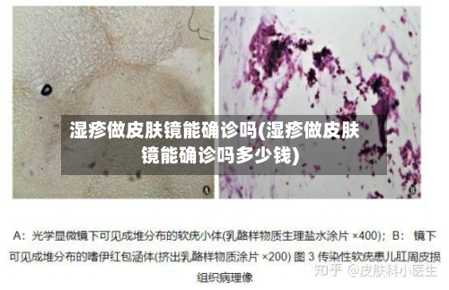 湿疹做皮肤镜能确诊吗(湿疹做皮肤镜能确诊吗多少钱)