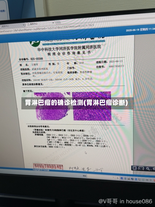 胃淋巴瘤的确诊检测(胃淋巴瘤诊断)-第2张图片