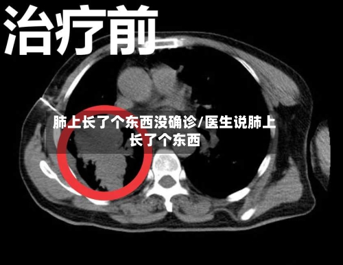 肺上长了个东西没确诊/医生说肺上长了个东西-第2张图片