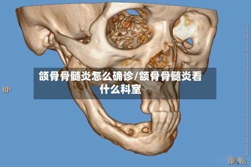 颌骨骨髓炎怎么确诊/颌骨骨髓炎看什么科室