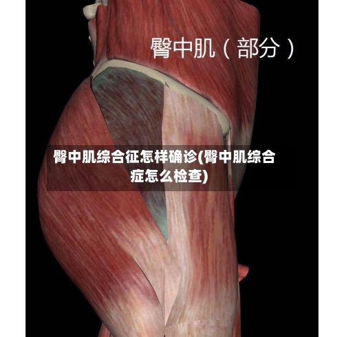 臀中肌综合征怎样确诊(臀中肌综合症怎么检查)