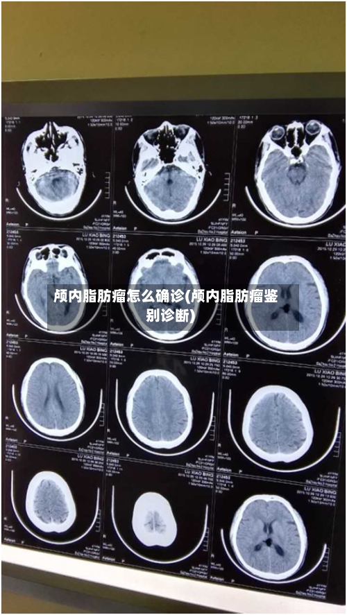 颅内脂肪瘤怎么确诊(颅内脂肪瘤鉴别诊断)-第2张图片