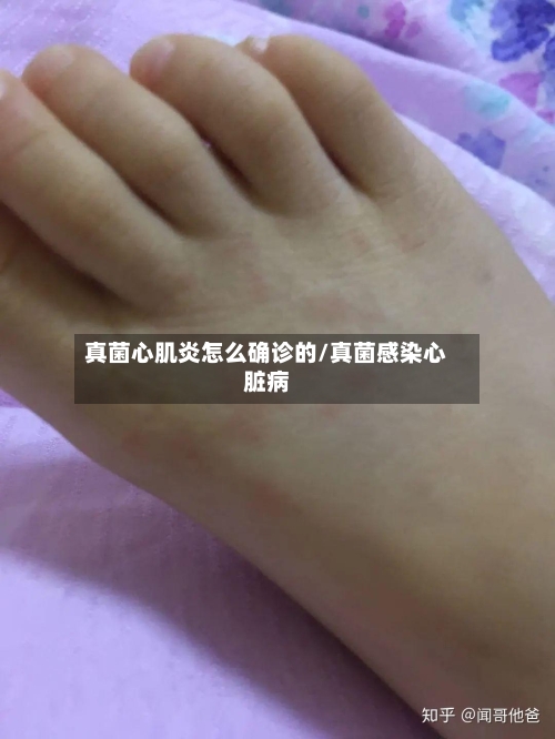 真菌心肌炎怎么确诊的/真菌感染心脏病-第3张图片