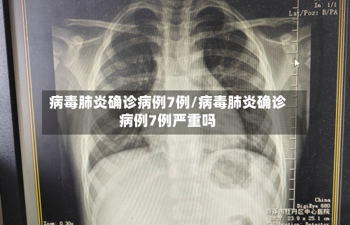 病毒肺炎确诊病例7例/病毒肺炎确诊病例7例严重吗-第2张图片