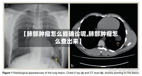 【肺部肿瘤怎么能确诊呢,肺部肿瘤怎么查出来】-第2张图片