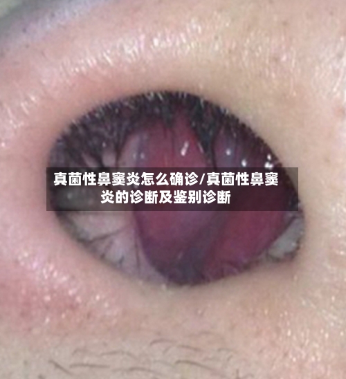 真菌性鼻窦炎怎么确诊/真菌性鼻窦炎的诊断及鉴别诊断-第2张图片